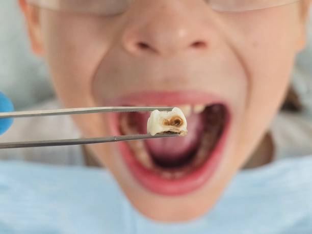 Best Broken or Cracked Tooth Emergency Dentist in Greenville, NY