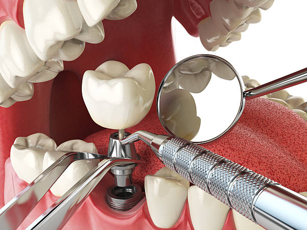 Best Emergency Dentist for Lost Fillings or Crowns in Greenville, NY